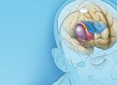 Illustration of deep brain stimulation in caudate nucleus