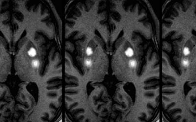 MRI-guided convection enhanced delivery of gene therapy for Parkinson's disease