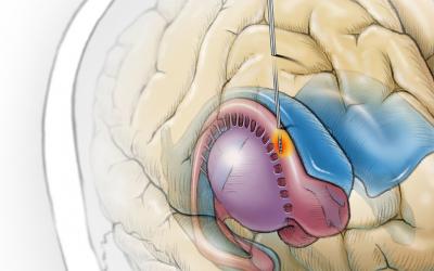 Illustration depicting deep brain stimulation in the caudate nucleus for treatment of tinnitus