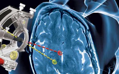 illustration of the clearpoint device for interventional MRI-guided surgery