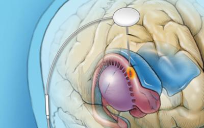 illustration of deep brain stimulation in the caudate nucleus