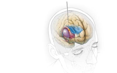 Illustration depicting deep brain stimulation in the caudate nucleus for treatment of tinnitus